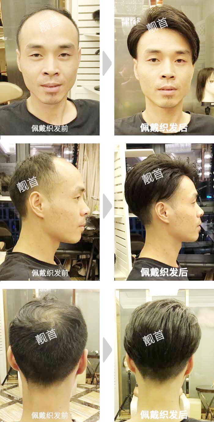 靓首官网 案例中心 男士 分类 背头/露发际线 内容正文          青年