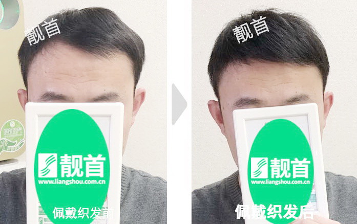 头顶稀少中年超短造型逼真宛如自生