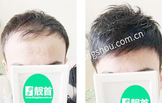 青年小面积韩式风格自由式减龄明显