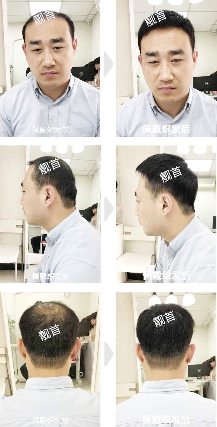 青年-短发-局部-男士补发织发实拍案例