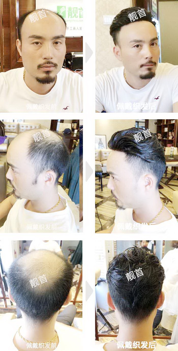 中年-局部-背头发际线-男士补发织发实拍案例