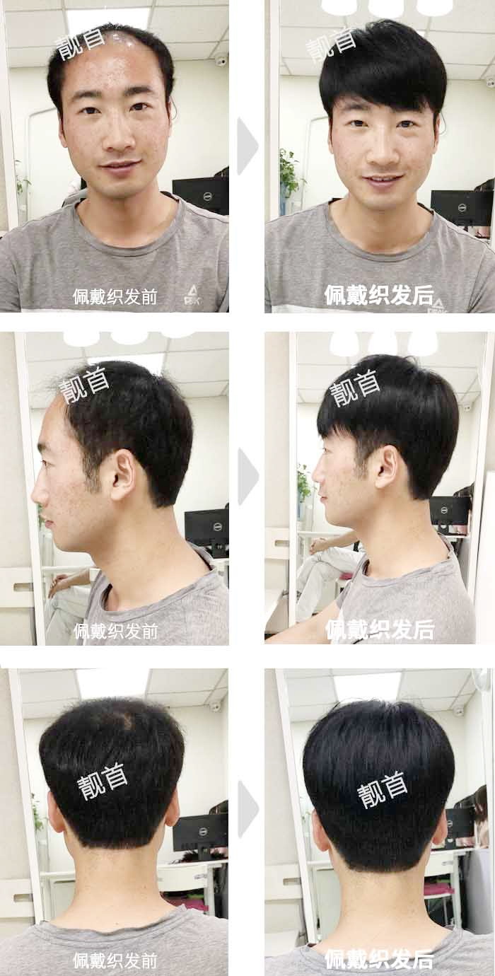 青年-自由式-局部-男士补发织发实拍案例