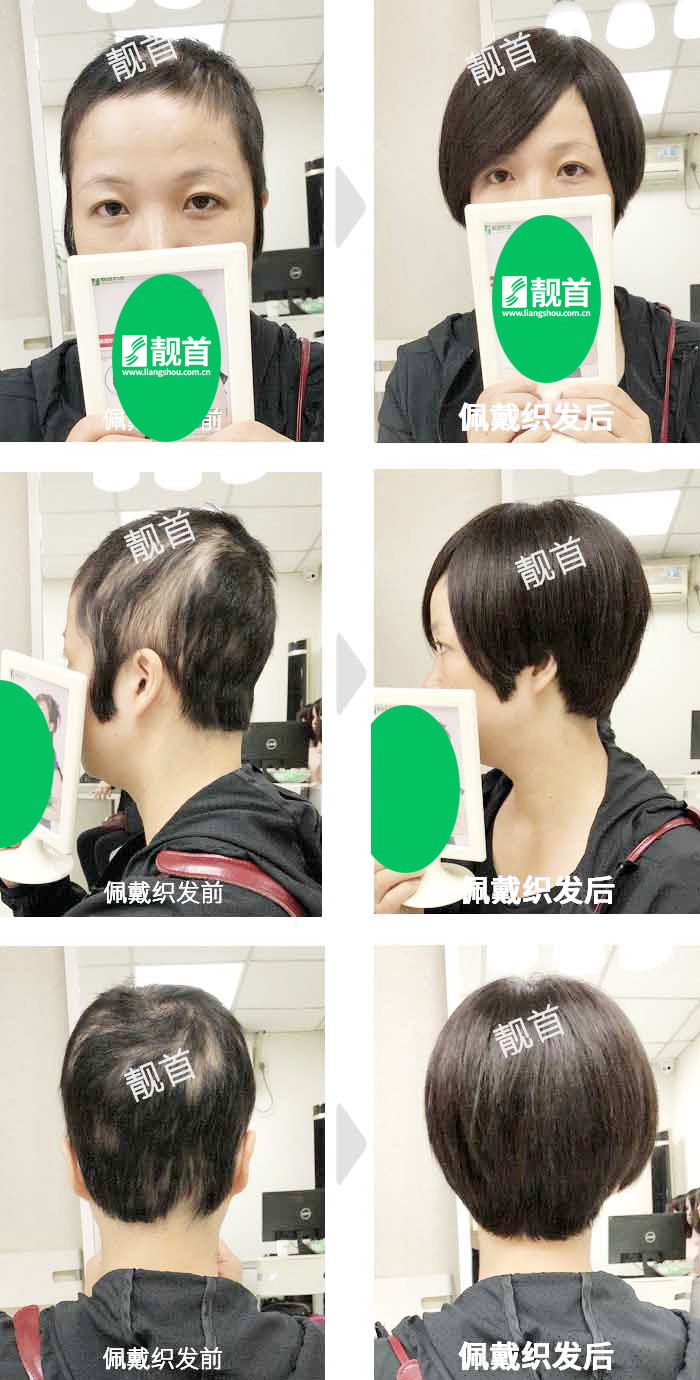 青年-头顶头发稀少-女士-织发补发真人发假发实拍案例